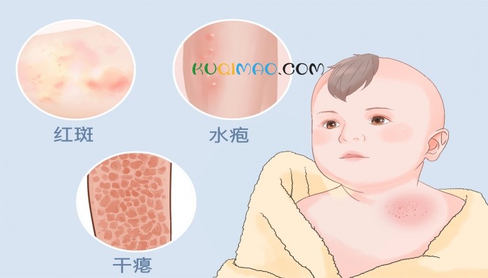 湖南一女子强吻1岁男童致其感染水痘 家长维权遇阻