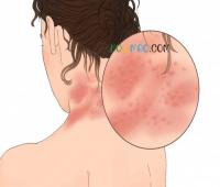 医生吃头孢遇险,“一不小心成为反面教材” 医生吃头孢遇险,“一不小心成为反面教材”