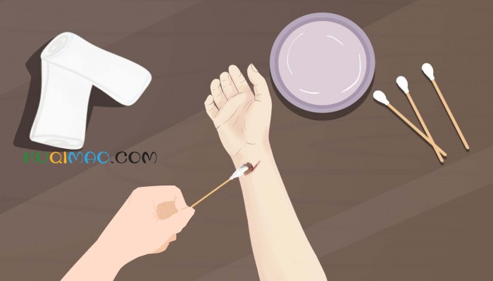 福建女子伤口结痂现白斑似发霉 网友劝说就医确认无虞